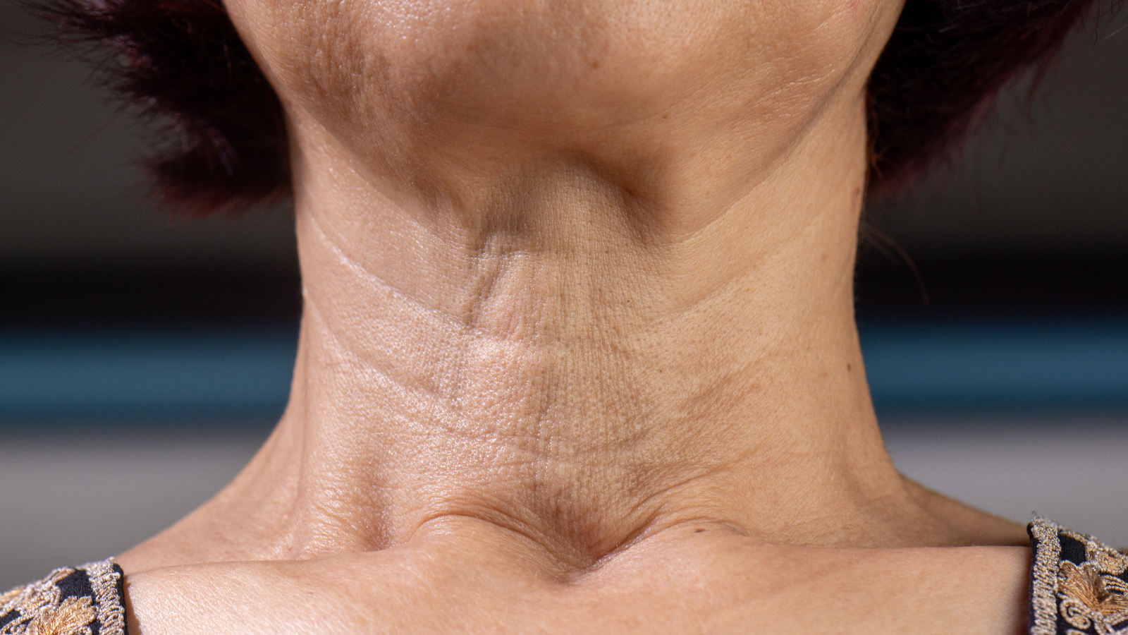 קמטים בצוואר תרופות סבתא